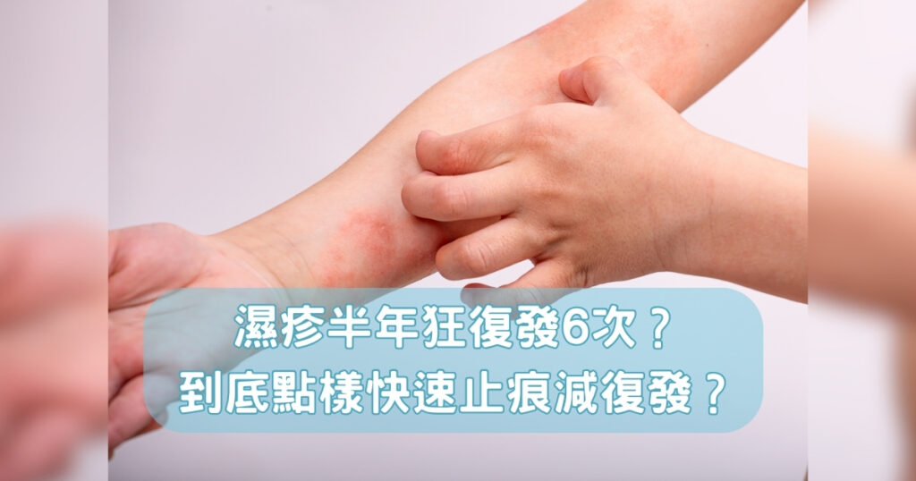 【濕疹治療】濕疹半年狂復發逾六次?到底怎樣才可以快速止痕降復發?